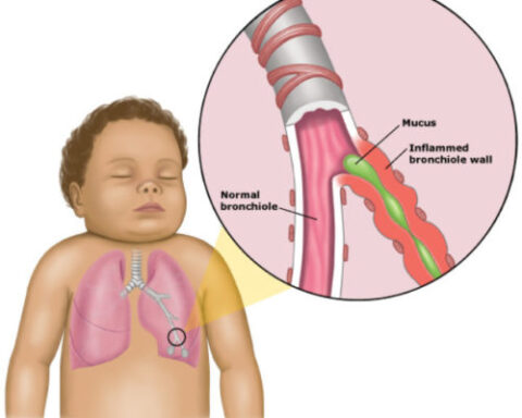 Nguyên nhân và các yếu tố nguy cơ gây viêm phế quản trẻ em