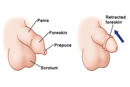 Bệnh hẹp bao quy đầu ở trẻ nhỏ và cách điều trị