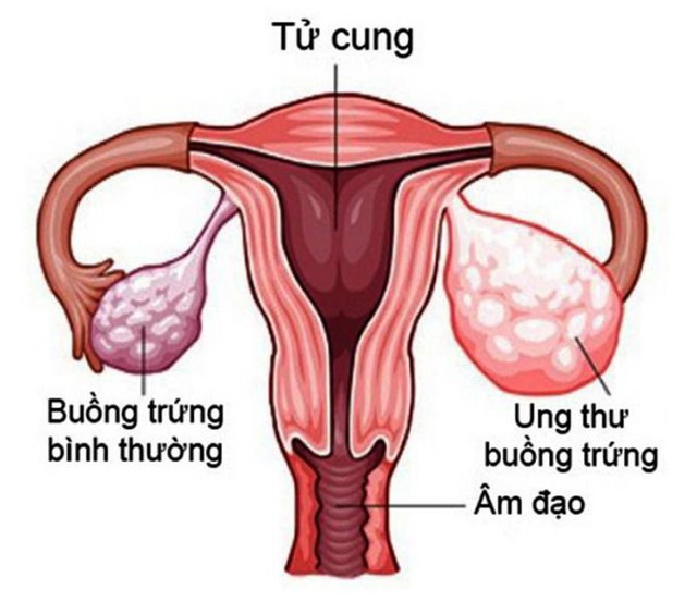 Các yếu tố nguy cơ gây ung thư buồng trứng - Ảnh 1.