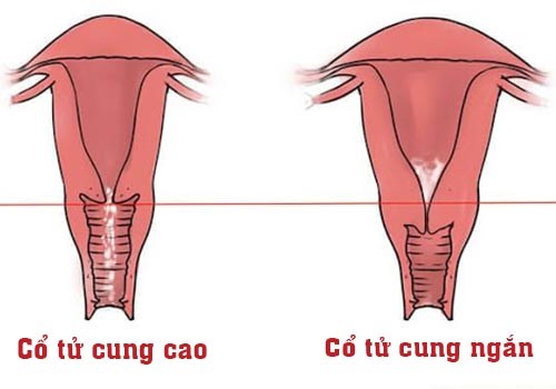 Ảnh hưởng của cổ tử cung ngắn khi mang thai - Ảnh 2.