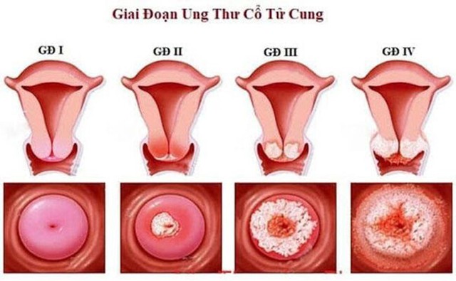 Ung thư cổ tử cung có chữa được không? - Ảnh 2.