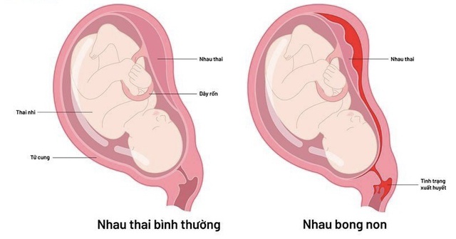 Giảm nguy cơ thai chết lưu - Ảnh 2.