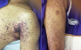 Người đàn ông ở Hà Nội tử vong sau vài ngày giết mổ lợn