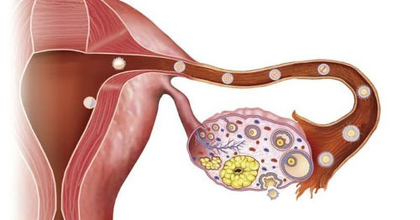 Nguyên nhân tiềm ẩn gây đau buồng trứng cần lưu ý - Ảnh 2.