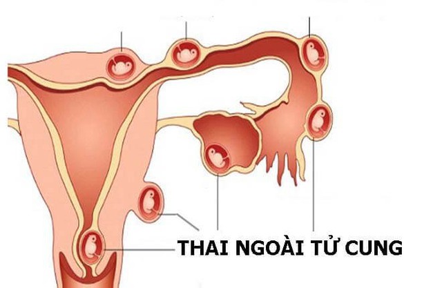 Chu kỳ kinh nguyệt ngắn là bình thường hay dấu hiệu nguy hiểm? - Ảnh 2.