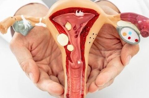 Polyp cổ tử cung có gây ra ung thư cổ tử cung?