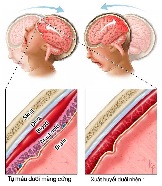 Hội chứng rung lắc ở trẻ em nguy hiểm thế nào? - Ảnh 4.