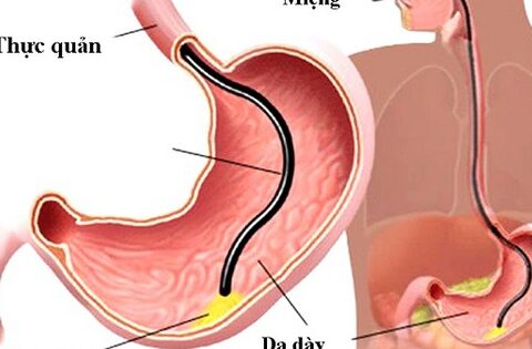 Nội soi tiêu hóa cho trẻ cần chú ý những gì?