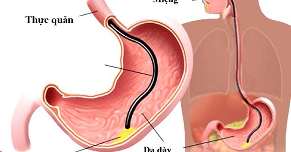 Nội soi tiêu hóa cho trẻ cần chú ý những gì?