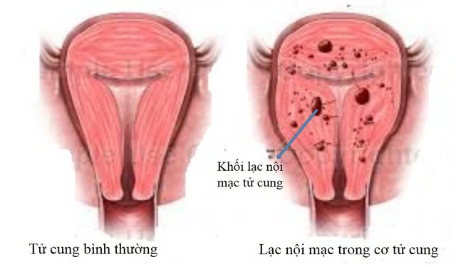 9 nguyên nhân phổ biến gây cơn đau dai dẳng vùng chậu ở phụ nữ - Ảnh 4.