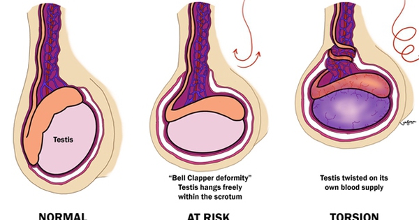 Đột ngột đau bìu do xoắn tinh hoàn, đến viện tinh hoàn đã tím đen