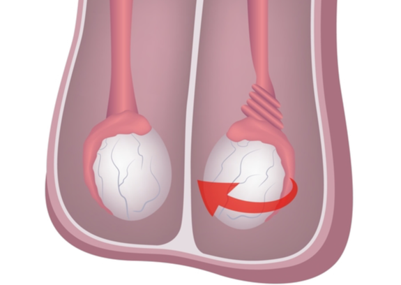 Nam sinh đột ngột đau bìu dữ dội, đến viện tinh hoàn đã tím đen - Ảnh 3.