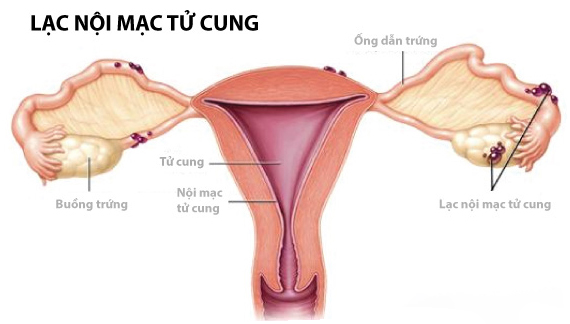 Dấu hiệu cảnh báo lạc nội mạc tử cung cần đi khám  - Ảnh 2.