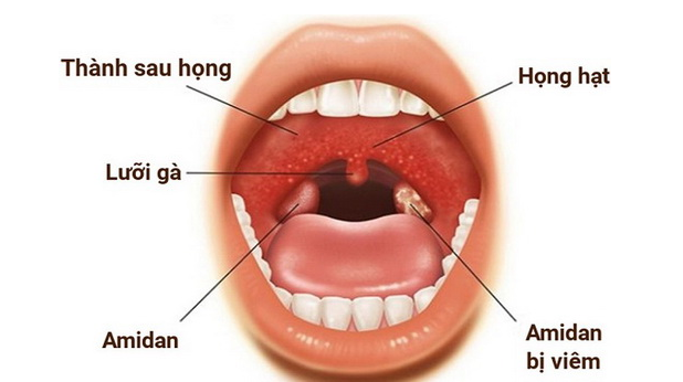 Áp xe thành sau họng - biến chứng nguy hiểm của viêm VA - Ảnh 2.