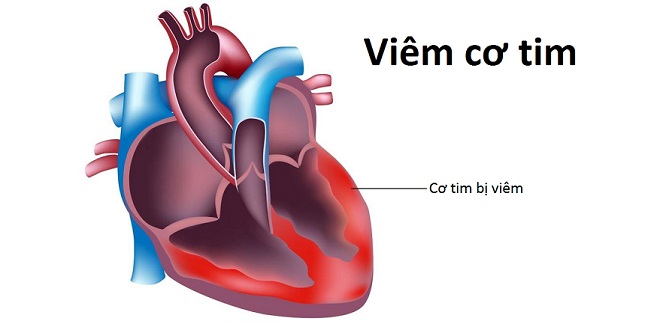 Bé trai nguy kịch sau 2 ngày sốt nhẹ, cha mẹ nhất định phải biết căn bệnh này - Ảnh 2.