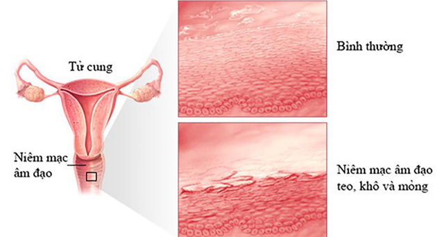 Nguyên nhân gây khô âm đạo và cách phòng ngừa - Ảnh 2.