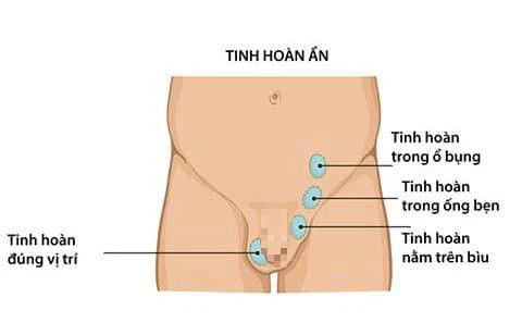 Điều gì xảy ra khi trẻ trai có tinh hoàn ẩn? - Ảnh 2.