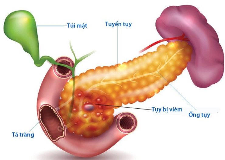 Bé trai 12 tuổi nôn nhiều lần được chẩn đoán viêm tụy cấp, những biểu hiện cần cảnh giác của căn bệnh này - Ảnh 2.