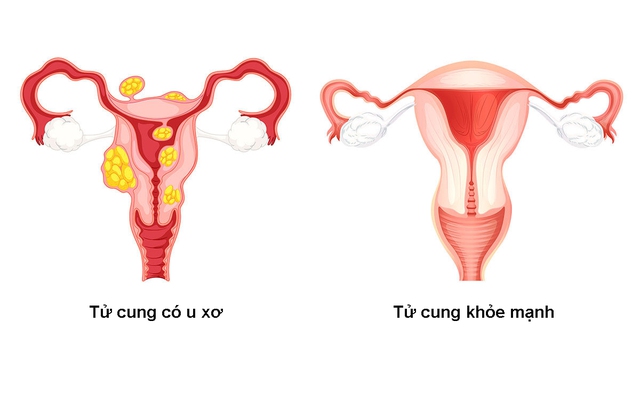 5 dấu hiệu cảnh báo u xơ tử cung - nhận biết sớm để can thiệp hiệu quả - Ảnh 2.