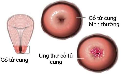 4 dấu hiệu chính cảnh báo ung thư cổ tử cung không nên bỏ qua - Ảnh 2.