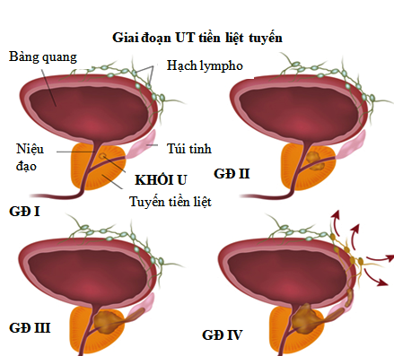 5 điều nam giới cần biết về ung thư tuyến tiền liệt - Ảnh 3.