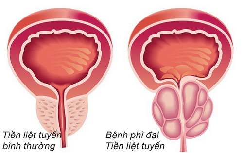 Phì đại tuyến tiền liệt có ảnh hưởng gì đến tình dục?- Ảnh 1.