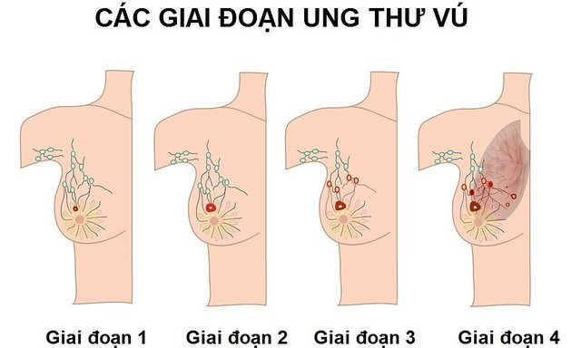 Sau chẩn đoán và điều trị ung thư vú sống được bao lâu?- Ảnh 1.