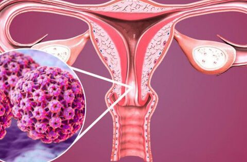 Virus HPV có thể gây những bệnh ung thư nào?