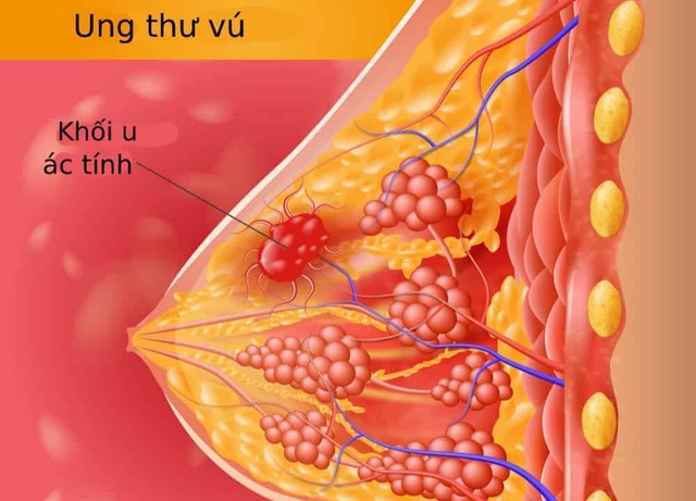 Cho con bú có giúp giảm nguy cơ ung thư vú?- Ảnh 1.