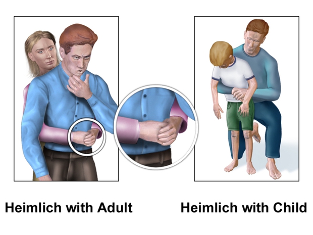 Phổi trái của bé trai 1 tuổi biến mất, thủ phạm bất ngờ là món ăn thường xuất hiện vào dịp Tết, phụ huynh cần cảnh giác - Ảnh 2.