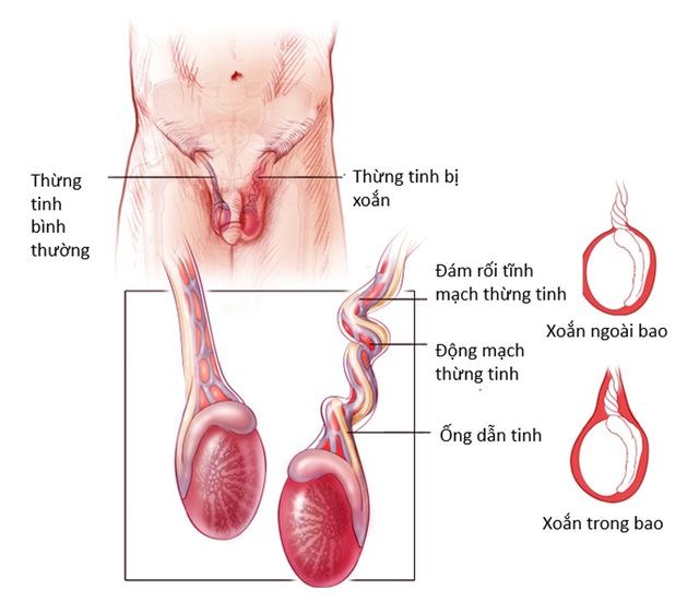 Thanh niên 16 tuổi bất ngờ bị xoắn tinh hoàn trong đêm, nhờ hành động này mà bác sĩ đã cứu được 'cậu nhỏ'- Ảnh 2.