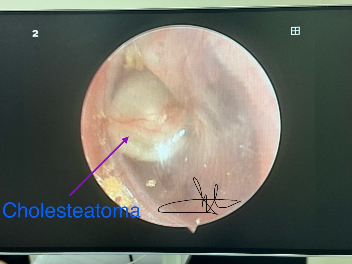 Bệnh Cholesteatoma bẩm sinh tai giữa và cách điều trị- Ảnh 1.