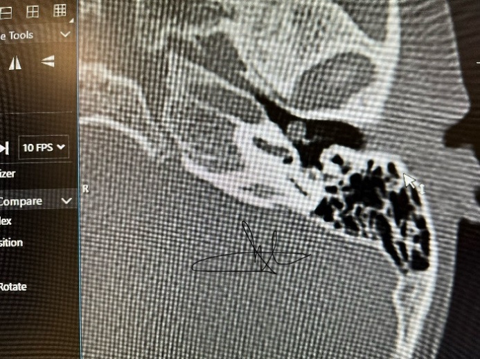 Bệnh Cholesteatoma bẩm sinh tai giữa và cách điều trị- Ảnh 5.