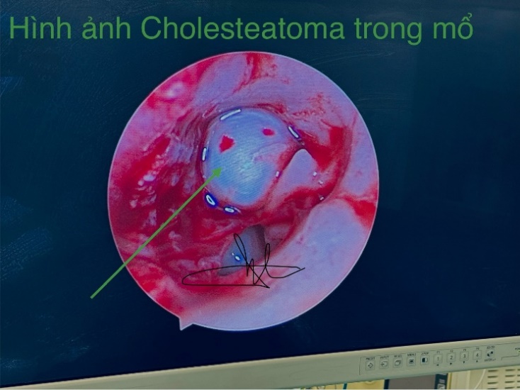 Bệnh Cholesteatoma bẩm sinh tai giữa và cách điều trị- Ảnh 6.