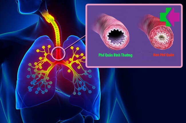 Ngày Hen toàn cầu 7/5 - Chủ động phòng bệnh hen phế quản tái phát- Ảnh 2.