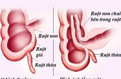 hoại tử ruột do lồng ruột và dấu hiệu lồng ruột