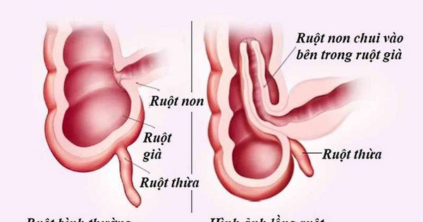 hoại tử ruột do lồng ruột và dấu hiệu lồng ruột