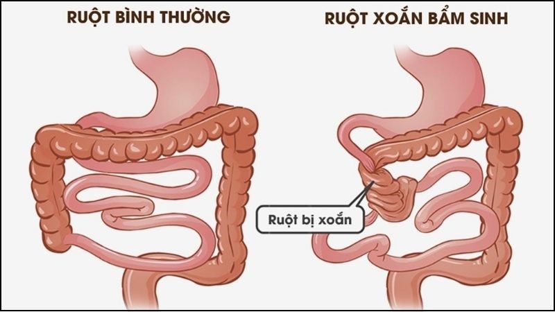 Dấu hiệu xoắn ruột ở trẻ sơ sinh- Ảnh 2.