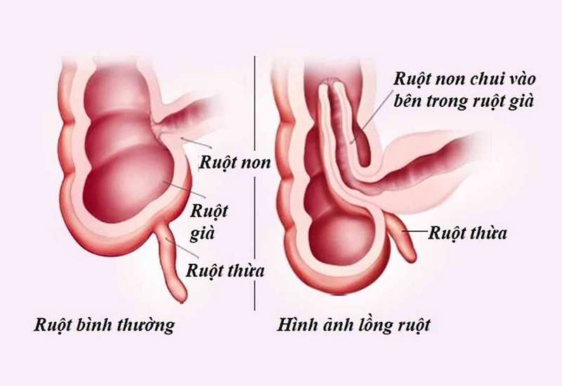 Trẻ 10 tháng tuổi bị hoại tử ruột do lồng ruột, cách nhận biết sớm căn bệnh nguy hiểm này- Ảnh 1.