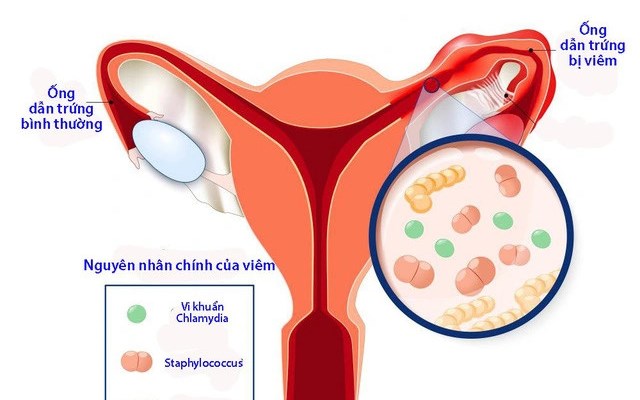 Bệnh nhân 14 tuổi viêm ứ mủ vòi tử cung dạng áp xe phần phụ