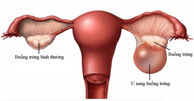 11 thực phẩm tốt cho người bị u nang buồng trứng- Ảnh 1.