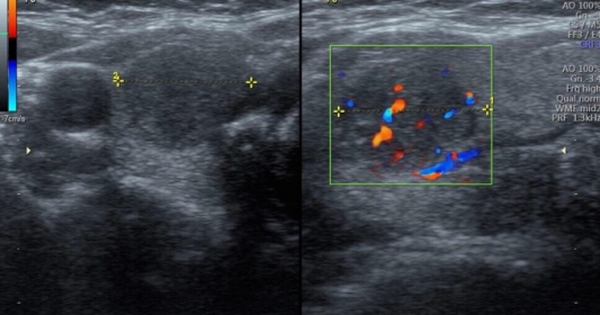 Ung thư tuyến giáp ngày càng trẻ hoá: Bác sĩ chỉ ra những dấu hiệu cần khám ngay nếu không muốn hối hận!