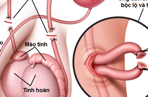 thắt ống dẫn tinh có gây vô sinh và yếu sinh lý?