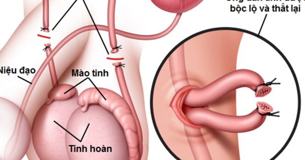 thắt ống dẫn tinh có gây vô sinh và yếu sinh lý?