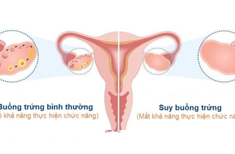 Suy buồng trứng: Nguyên nhân, triệu chứng, cách phòng ngừa