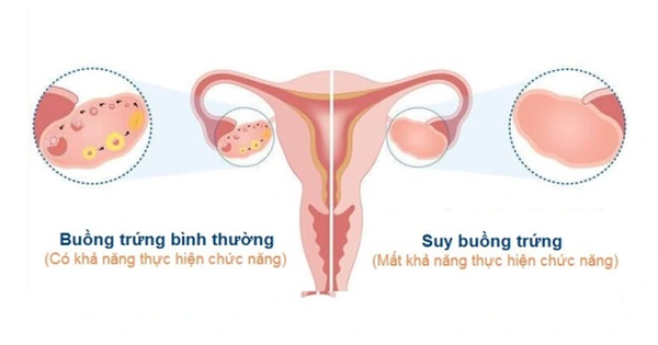 Suy buồng trứng: Nguyên nhân, triệu chứng, cách phòng ngừa