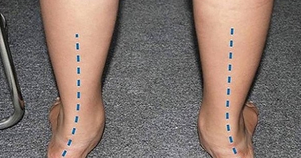 Bàn chân bẹt: Nguyên nhân, biểu hiện, cách điều trị và phòng bệnh