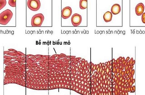 Loạn sản cổ tử cung: Nguyên nhân, triệu chứng, cách điều trị và phòng ngừa