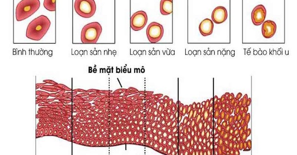 Loạn sản cổ tử cung: Nguyên nhân, triệu chứng, cách điều trị và phòng ngừa