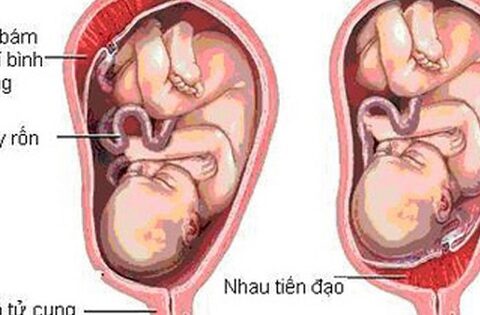 Nhau tiền đạo: Nguyên nhân, triệu chứng, cách điều trị và phòng ngừa